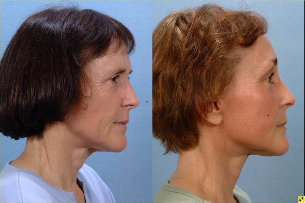 woman who had facelift plastic surgery